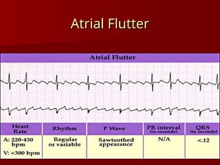 complete ECG interpretation presentation.ppt