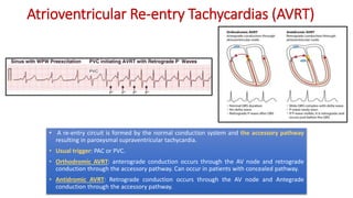 Retrograde Accessory Pathway Complete EKG Interpretation Course | PPTX