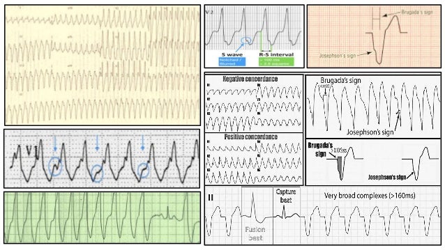 Complete Ekg Interpretation Course
