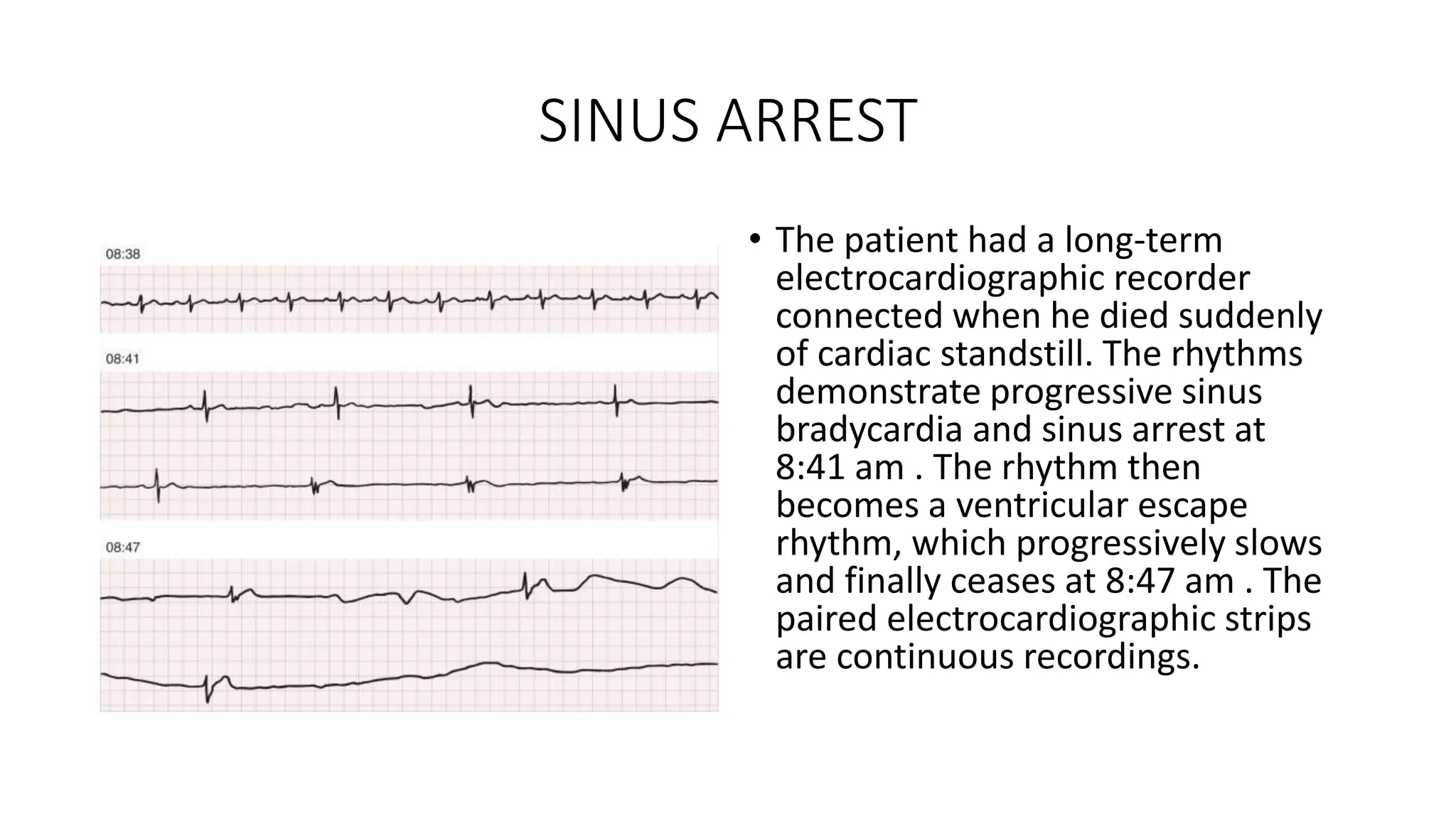 SINUS ARREST
• The patient had a long-term
electrocardiographic recorder
connected when he died suddenly
of cardiac standstill. The rhythms
demonstrate progressive sinus
bradycardia and sinus arrest at
8:41 am . The rhythm then
becomes a ventricular escape
rhythm, which progressively slows
and finally ceases at 8:47 am . The
paired electrocardiographic strips
are continuous recordings.
 