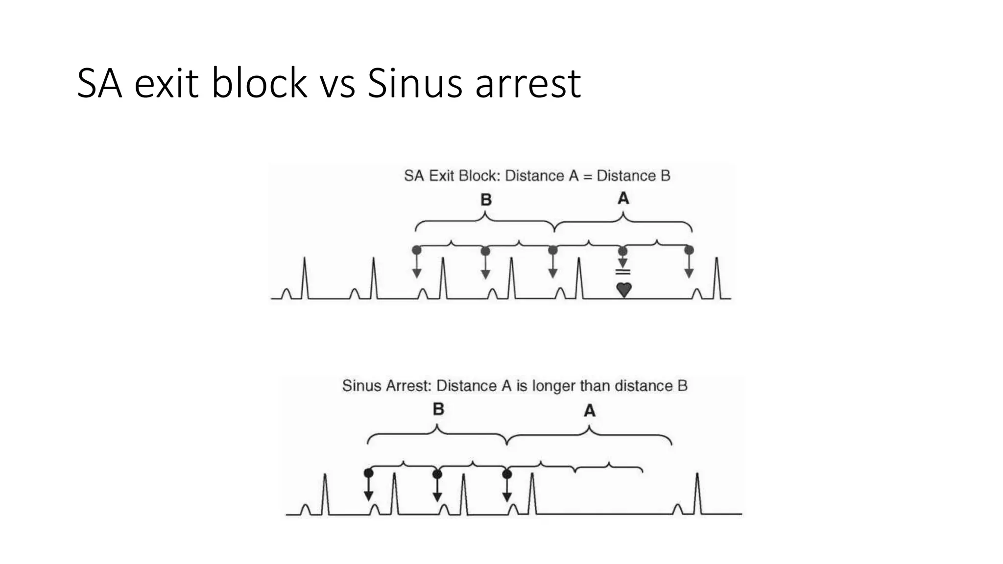 SA exit block vs Sinus arrest
 