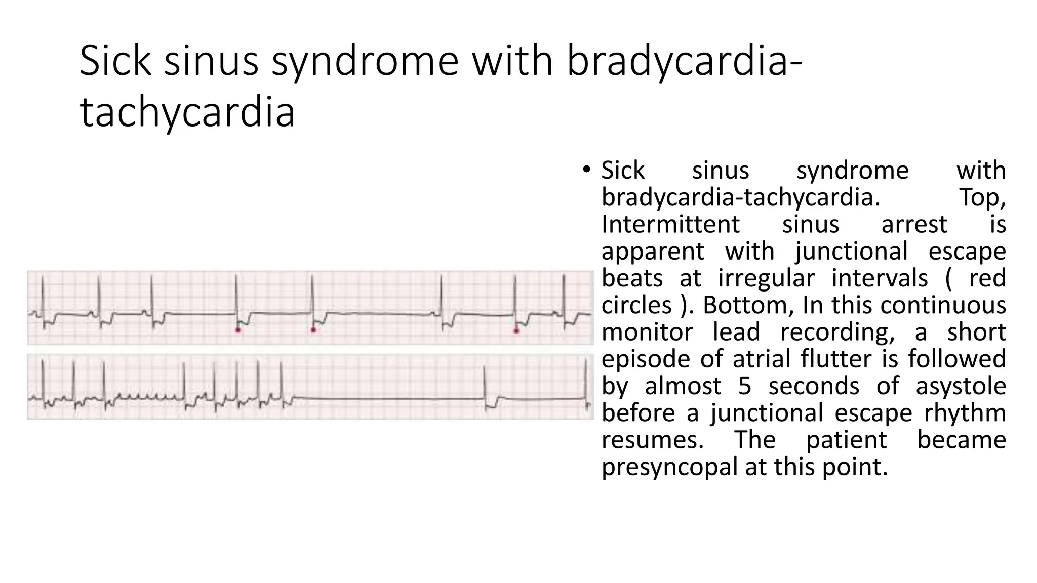 Sick sinus syndrome with bradycardia-
tachycardia
• Sick sinus syndrome with
bradycardia-tachycardia. Top,
Intermittent sinus arrest is
apparent with junctional escape
beats at irregular intervals ( red
circles ). Bottom, In this continuous
monitor lead recording, a short
episode of atrial flutter is followed
by almost 5 seconds of asystole
before a junctional escape rhythm
resumes. The patient became
presyncopal at this point.
 