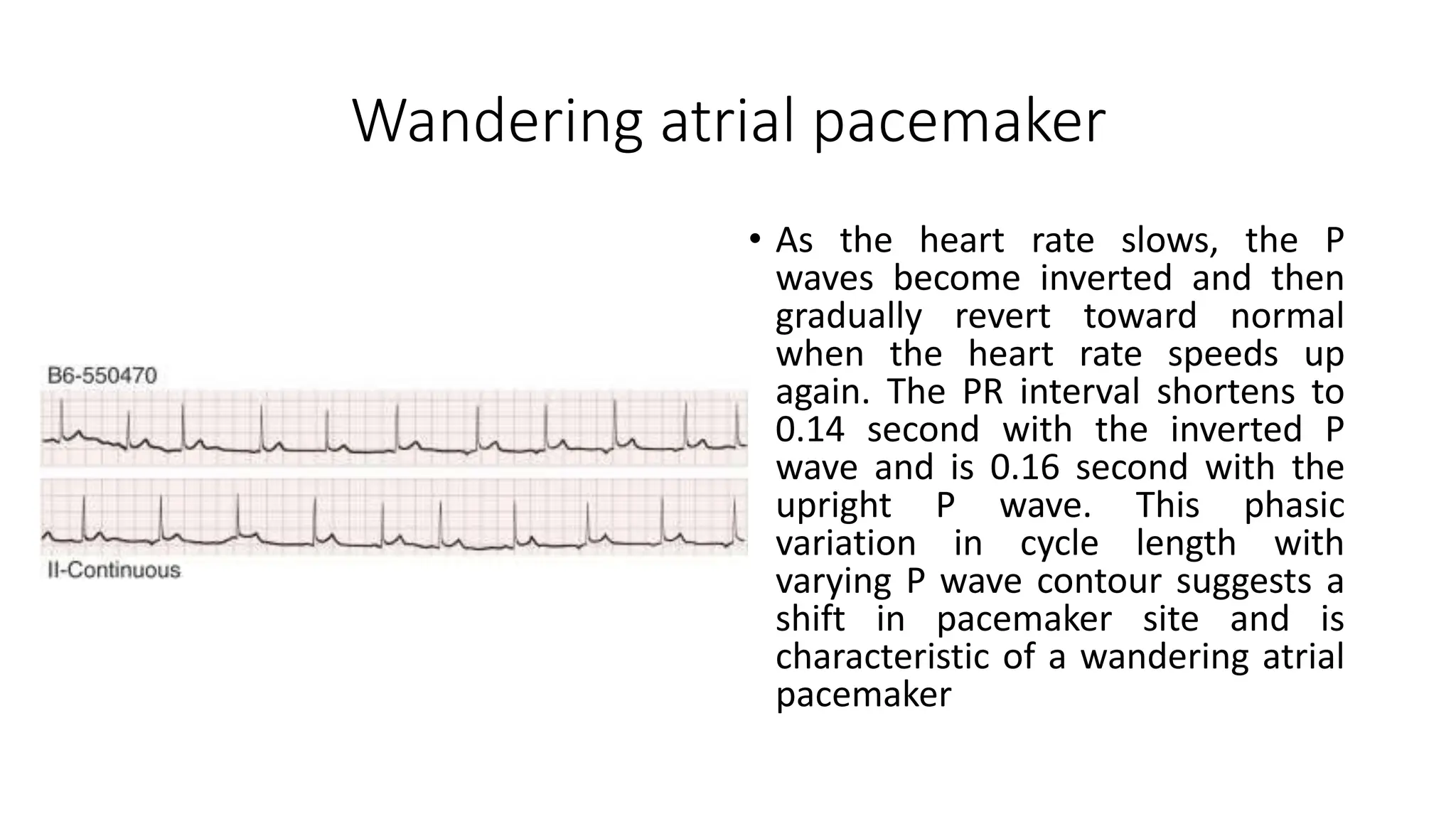 Wandering atrial pacemaker
• As the heart rate slows, the P
waves become inverted and then
gradually revert toward normal
when the heart rate speeds up
again. The PR interval shortens to
0.14 second with the inverted P
wave and is 0.16 second with the
upright P wave. This phasic
variation in cycle length with
varying P wave contour suggests a
shift in pacemaker site and is
characteristic of a wandering atrial
pacemaker
 