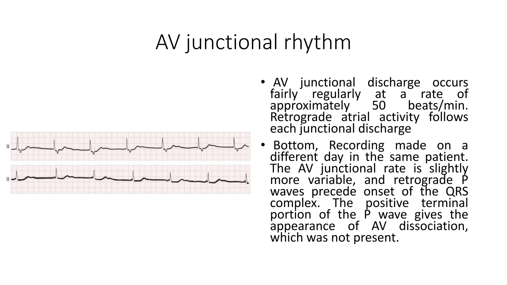 AV junctional rhythm
• AV junctional discharge occurs
fairly regularly at a rate of
approximately 50 beats/min.
Retrograde atrial activity follows
each junctional discharge
• Bottom, Recording made on a
different day in the same patient.
The AV junctional rate is slightly
more variable, and retrograde P
waves precede onset of the QRS
complex. The positive terminal
portion of the P wave gives the
appearance of AV dissociation,
which was not present.
 