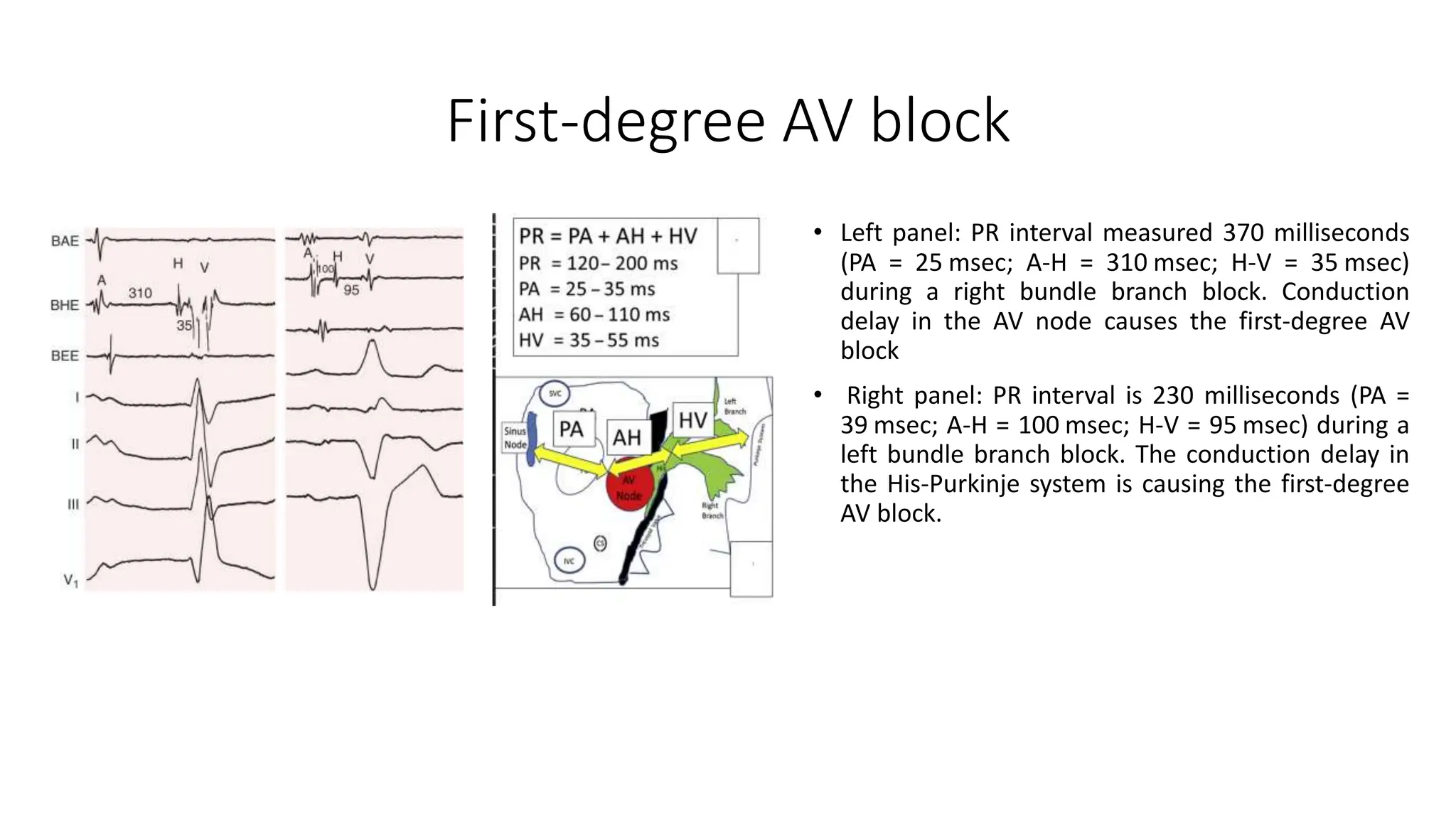 First-degree AV block
• Left panel: PR interval measured 370 milliseconds
(PA = 25 msec; A-H = 310 msec; H-V = 35 msec)
during a right bundle branch block. Conduction
delay in the AV node causes the first-degree AV
block
• Right panel: PR interval is 230 milliseconds (PA =
39 msec; A-H = 100 msec; H-V = 95 msec) during a
left bundle branch block. The conduction delay in
the His-Purkinje system is causing the first-degree
AV block.
 