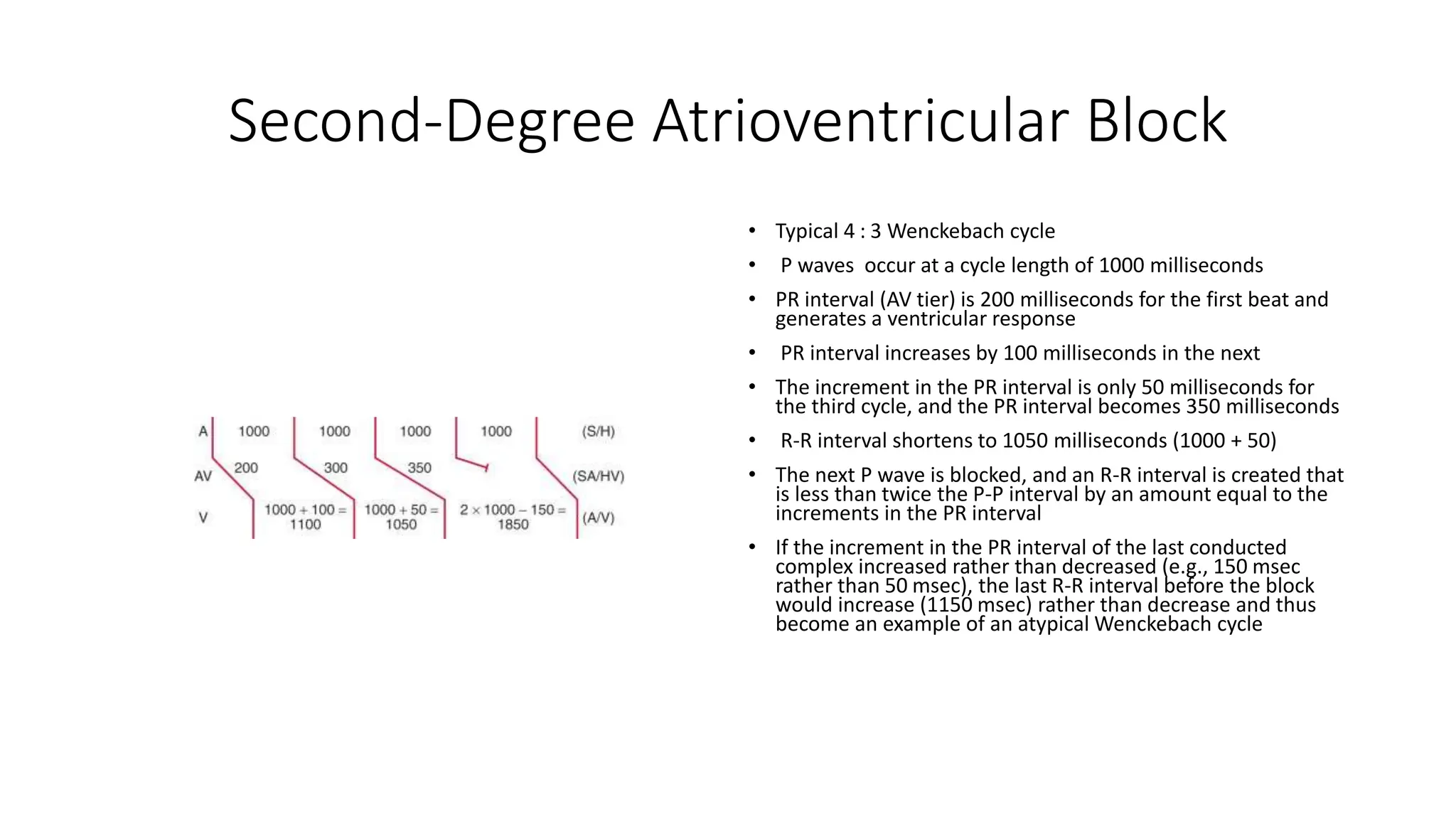 Second-Degree Atrioventricular Block
• Typical 4 : 3 Wenckebach cycle
• P waves occur at a cycle length of 1000 milliseconds
• PR interval (AV tier) is 200 milliseconds for the first beat and
generates a ventricular response
• PR interval increases by 100 milliseconds in the next
• The increment in the PR interval is only 50 milliseconds for
the third cycle, and the PR interval becomes 350 milliseconds
• R-R interval shortens to 1050 milliseconds (1000 + 50)
• The next P wave is blocked, and an R-R interval is created that
is less than twice the P-P interval by an amount equal to the
increments in the PR interval
• If the increment in the PR interval of the last conducted
complex increased rather than decreased (e.g., 150 msec
rather than 50 msec), the last R-R interval before the block
would increase (1150 msec) rather than decrease and thus
become an example of an atypical Wenckebach cycle
 