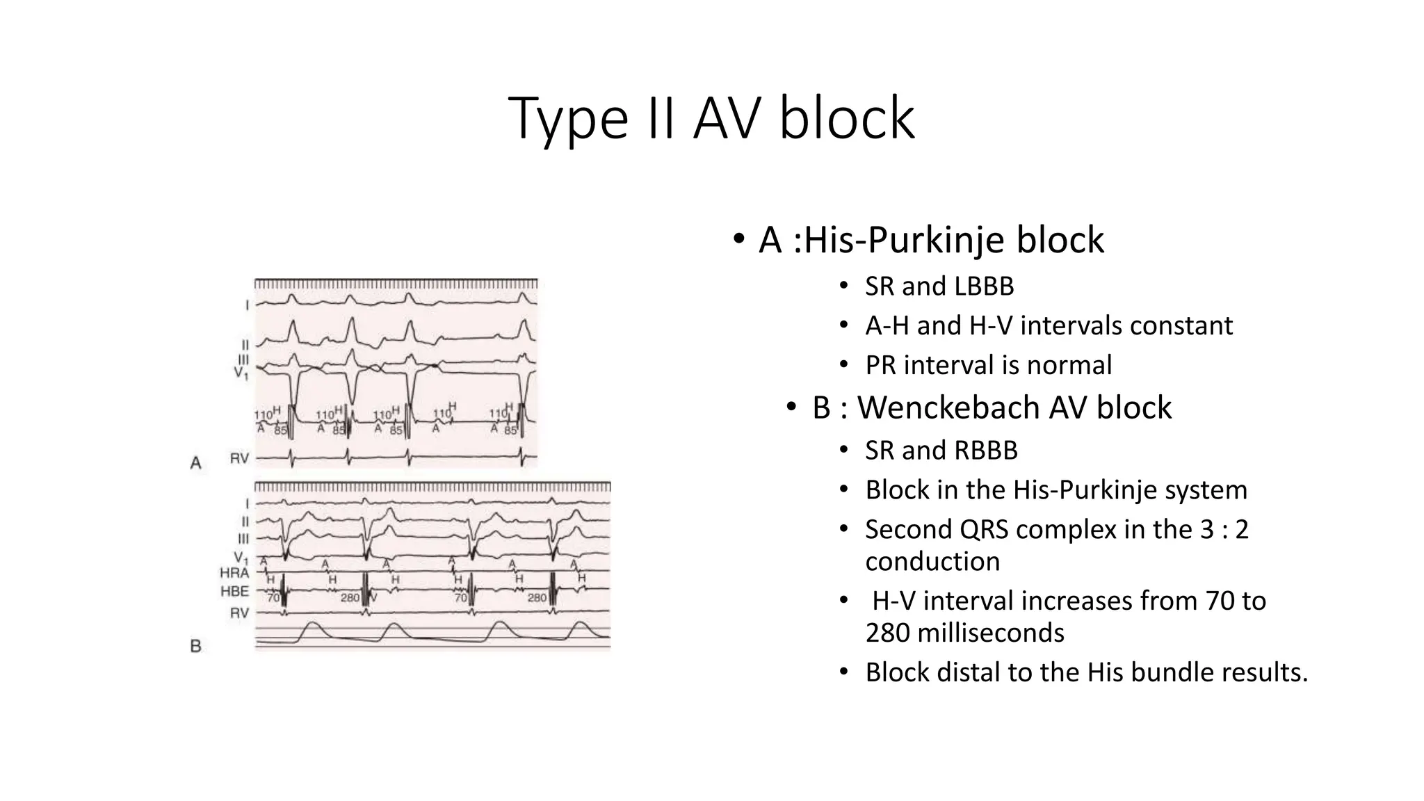 Type II AV block
• A :His-Purkinje block
• SR and LBBB
• A-H and H-V intervals constant
• PR interval is normal
• B : Wenckebach AV block
• SR and RBBB
• Block in the His-Purkinje system
• Second QRS complex in the 3 : 2
conduction
• H-V interval increases from 70 to
280 milliseconds
• Block distal to the His bundle results.
 