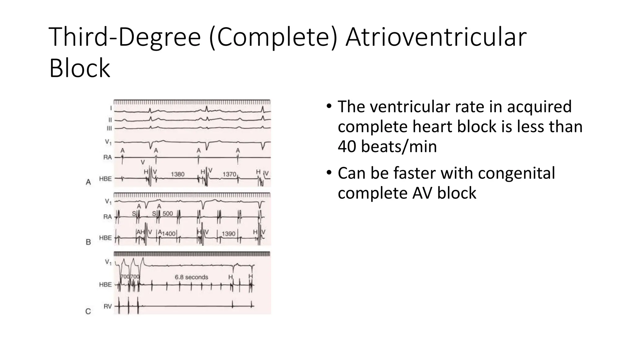 Third-Degree (Complete) Atrioventricular
Block
• The ventricular rate in acquired
complete heart block is less than
40 beats/min
• Can be faster with congenital
complete AV block
 
