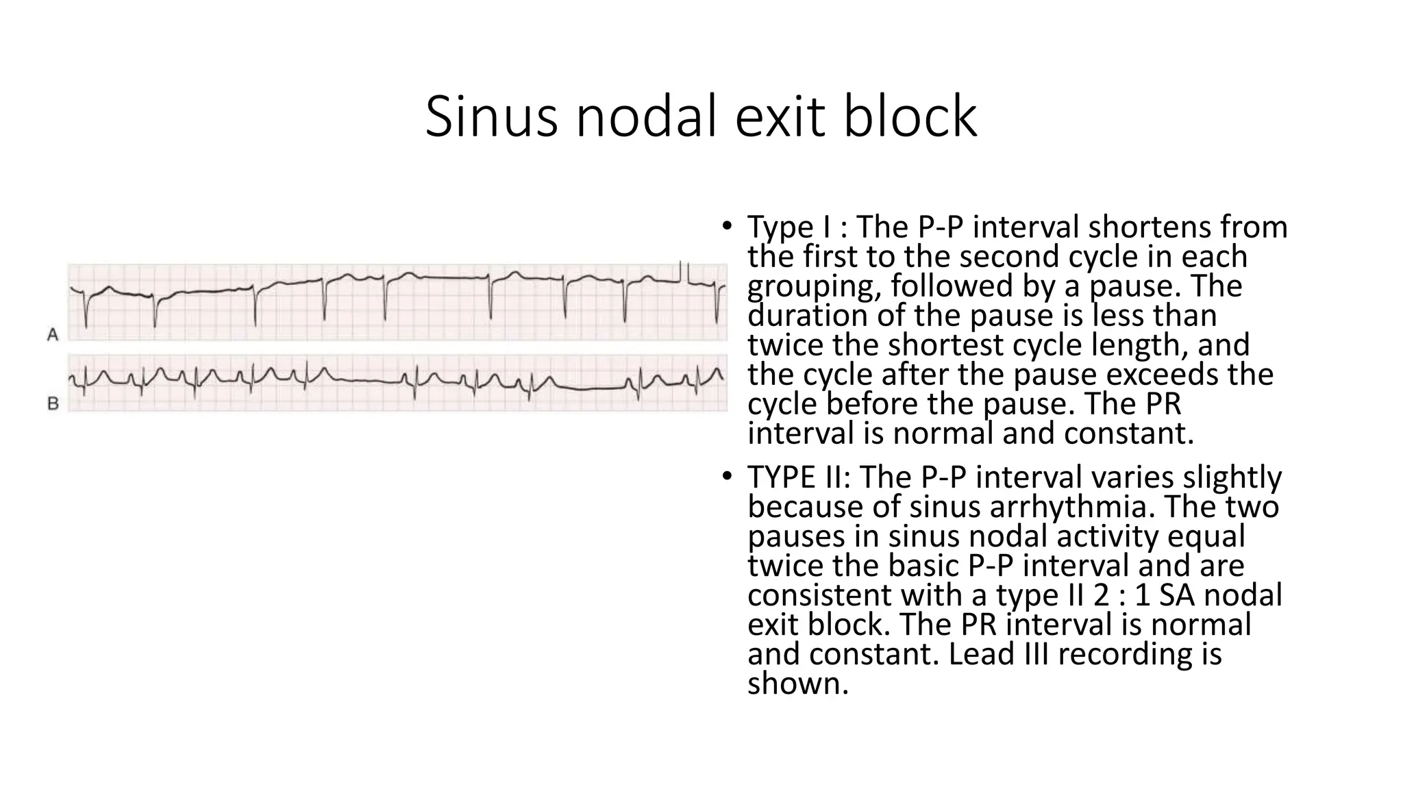 Sinus nodal exit block
• Type I : The P-P interval shortens from
the first to the second cycle in each
grouping, followed by a pause. The
duration of the pause is less than
twice the shortest cycle length, and
the cycle after the pause exceeds the
cycle before the pause. The PR
interval is normal and constant.
• TYPE II: The P-P interval varies slightly
because of sinus arrhythmia. The two
pauses in sinus nodal activity equal
twice the basic P-P interval and are
consistent with a type II 2 : 1 SA nodal
exit block. The PR interval is normal
and constant. Lead III recording is
shown.
 