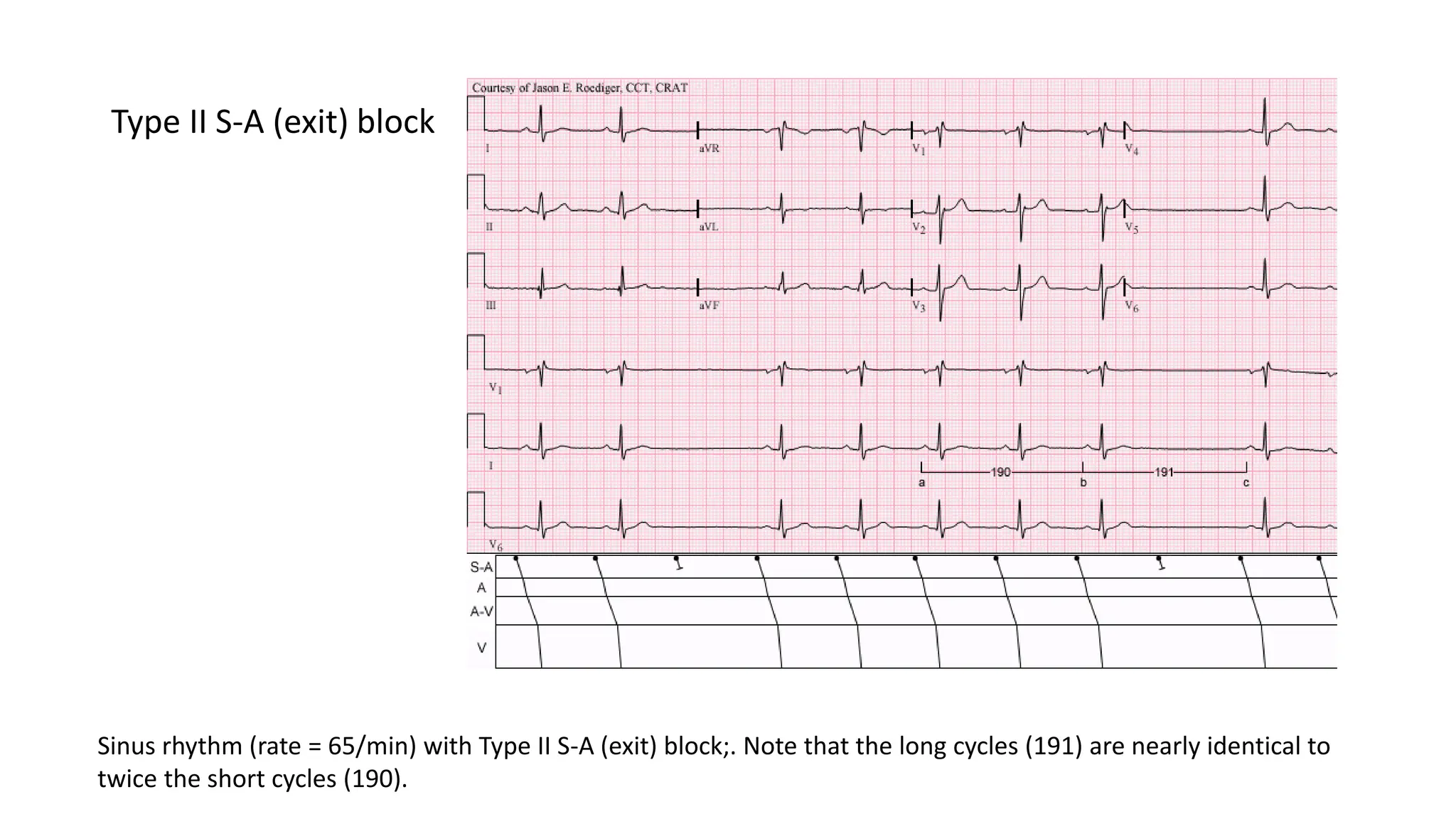 Type II S-A (exit) block
Sinus rhythm (rate = 65/min) with Type II S-A (exit) block;. Note that the long cycles (191) are nearly identical to
twice the short cycles (190).
 
