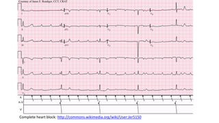Degenerative complete heart block: basics and diagnostics | PDF