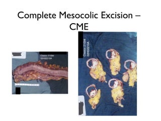 Complete Mesocolic Excision –
CME
 