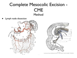 Complete Mesocolic Excision -
CME
Method
• Lymph node dissection
 