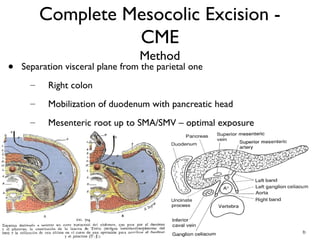 Complete Mesocolic Excision -
CME
Method
• Separation visceral plane from the parietal one
– Right colon
– Mobilization of duodenum with pancreatic head
– Mesenteric root up to SMA/SMV – optimal exposure
 