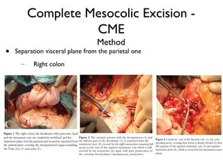 Complete Mesocolic Excision -
CME
Method
• Separation visceral plane from the parietal one
– Right colon
 