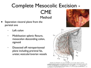Complete Mesocolic Excision -
CME
Method
• Separation visceral plane from the
parietal one
– Left colon
– Mobilisation splenic flexure,
mesocolon descending colon,
sigmoid
– Dissected off retroperitoneal
plane including prerenal fat,
ureter, vesicular/ovarian vessels
 