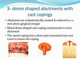 3- dome shaped abutments with
cast copings
 Abutment are endodontically treated & reduced to 1-2
mm above gingival margin
 Metal dome shaped cast coping constructed to cover
abutment
 The metal coping has a short post cemented into root
canal to retain the coping
 