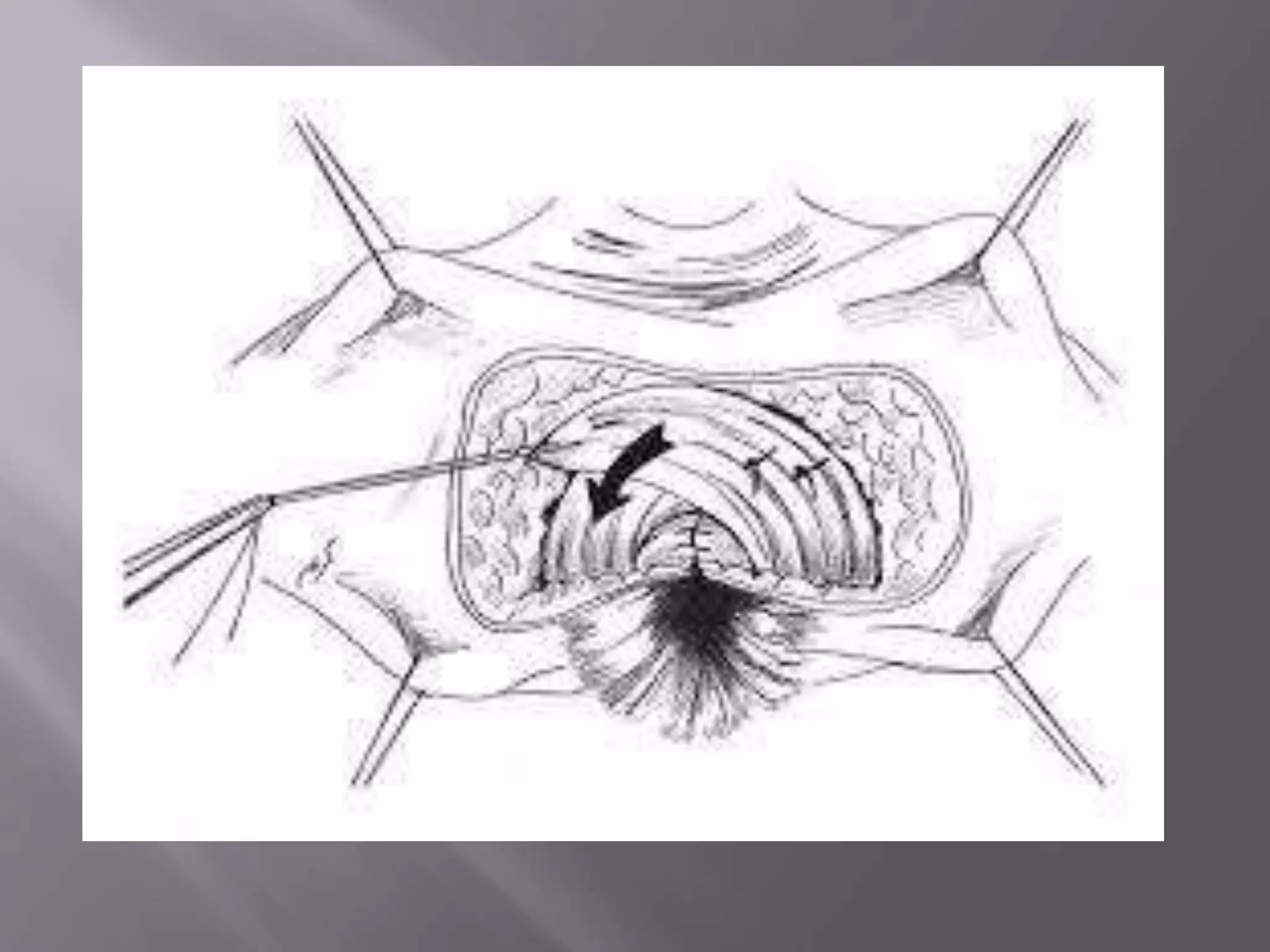 Complete perineal tear | PPTX - All For One