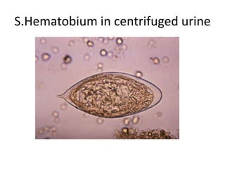S.Hematobium in centrifuged urine
 