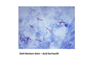 Ziehl Neelsen Stain – Acid fast bacilli
 
