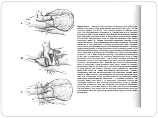OTHER TECHNIQUES: 
1. BEX TECHNIQUE: 
 The subaortic conus is divided so that the whole 
aortic root, together with a mus...