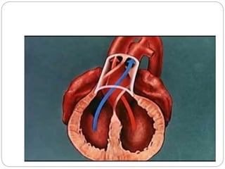 DEFINITION 
 Complete transposition of the great arteries 
(TGA) is a congenital cardiac anomaly in which 
the aorta aris...