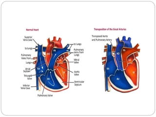 MORPHOLOGY 
1. Right Ventricle 
 The RV is normally positioned, hypertrophied, and large in TGA. 
 In about 90% of cases...
