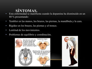 SÍNTOMAS.
• Esta enfermedad se manifiesta cuando la dopamina ha disminuido en un
80 % presentando:
• Temblor en las manos, los brazos, las piernas, la mandíbula y la cara.
• Rigidez en los brazos, las piernas y el tronco.
• Lentitud de los movimientos.
• Problemas de equilibrio y coordinación.
 