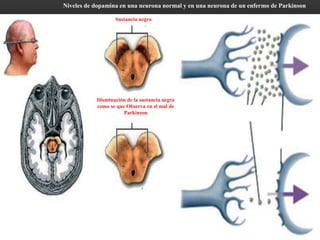 QF. MARIO A. BOLARTE ARTEAGA
Sección de corte de la
parte media del cerebro
donde es visible una
porción de la sustancia
negra.
Disminución de la sustancia negra
como se que Observa en el mal de
Parkinson
Sustancia negra
Niveles de dopamina en una neurona normal y en una neurona de un enfermo de Parkinson
Neurona Normal
Neurona en
enfermedad de
Parkinson
Movimiento
Normal
Desórdenes
de
movimiento
DOPAMINA
RECEPTORES
 
