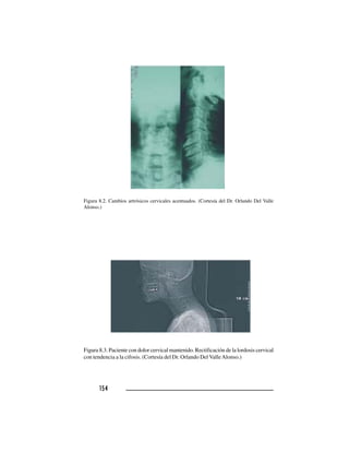 154154154154154
Figura 8.2. Cambios artrósicos cervicales acentuados. (Cortesía del Dr. Orlando Del Valle
Alonso.)
Figura 8.3. Paciente con dolor cervical mantenido. Rectificación de la lordosis cervical
con tendencia a la cifosis. (Cortesía del Dr. Orlando Del ValleAlonso.)
 