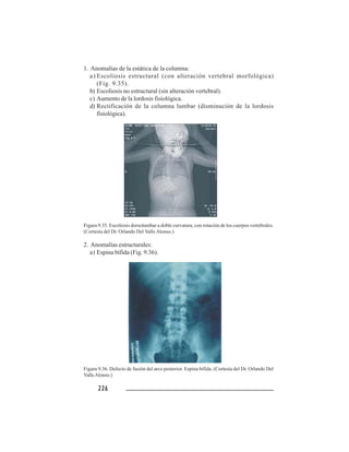 226226226226226
1. Anomalías de la estática de la columna:
a) Escoliosis estructural (con alteración vertebral morfológica)
(Fig. 9.35).
b) Escoliosis no estructural (sin alteración vertebral).
c) Aumento de la lordosis fisiológica.
d) Rectificación de la columna lumbar (disminución de la lordosis
fisiológica).
Figura 9.35. Escoliosis dorsolumbar a doble curvatura, con rotación de los cuerpos vertebrales.
(Cortesía del Dr. Orlando Del Valle Alonso.)
2. Anomalías estructurales:
a) Espina bífida (Fig. 9.36).
Figura 9.36. Defecto de fusión del arco posterior. Espina bífida. (Cortesía del Dr. Orlando Del
ValleAlonso.)
 