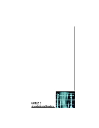 6 36 36 36 36 3
Artroplastia total de cadera
CAPÍTULO 3CAPÍTULO 3CAPÍTULO 3CAPÍTULO 3CAPÍTULO 3
 