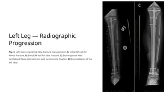 Complex Bilateral Lower Extremity Limb Salvage Using a ...