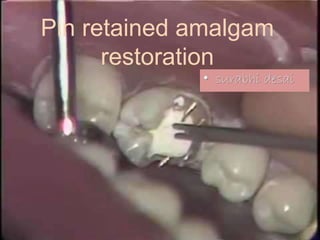 Pin retained amalgam
restoration
• surabhi desai
 