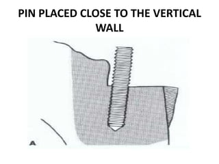 PIN PLACED CLOSE TO THE VERTICAL WALL