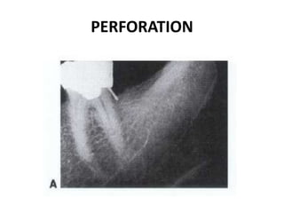 PERFORATION