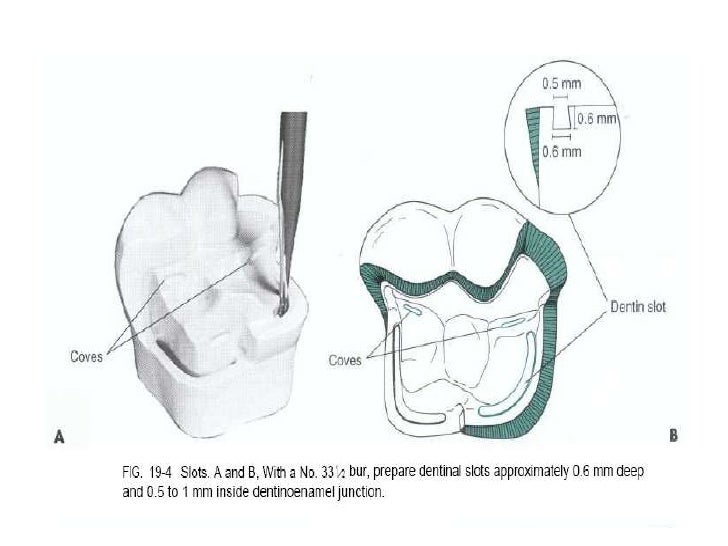 Complex amalgam restoration