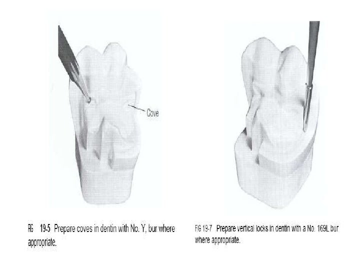 Complex amalgam restoration
