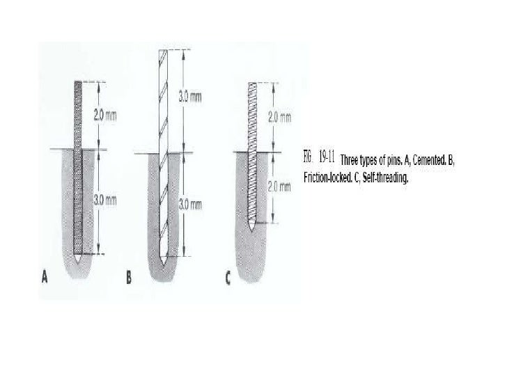 Complex amalgam restoration