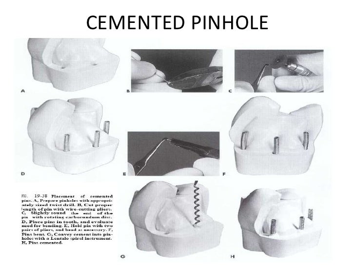 Complex amalgam restoration