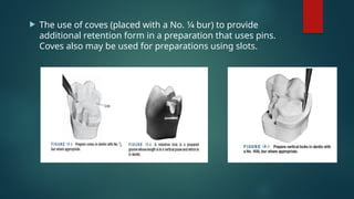  The use of coves (placed with a No. 1⁄4 bur) to provide
additional retention form in a preparation that uses pins.
Coves also may be used for preparations using slots.
 