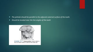 The pinhole should be parallel to the adjacent external surface of the tooth.
 Should be located near the line angles of the tooth
 