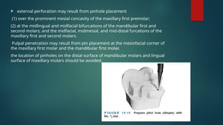  external perforation may result from pinhole placement
(1) over the prominent mesial concavity of the maxillary first premolar;
(2) at the midlingual and midfacial bifurcations of the mandibular first and
second molars; and the midfacial, midmesial, and mid-distal furcations of the
maxillary first and second molars.
Pulpal penetration may result from pin placement at the mesiofacial corner of
the maxillary first molar and the mandibular first molar.
the location of pinholes on the distal surface of mandibular molars and lingual
surface of maxillary molars should be avoided.
 