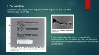  Pin insertion
conventional latch-type contra-angle handpiece (Fig. 19-32) and TMS hand
wrenches (see Fig. 19-30).
The latch-type handpiece is recommended for
the insertion of the Link Series and the Link Plus pins.
The hand wrench is recommended for the insertion of
standard pins.
 