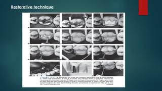 Restorative technique
 