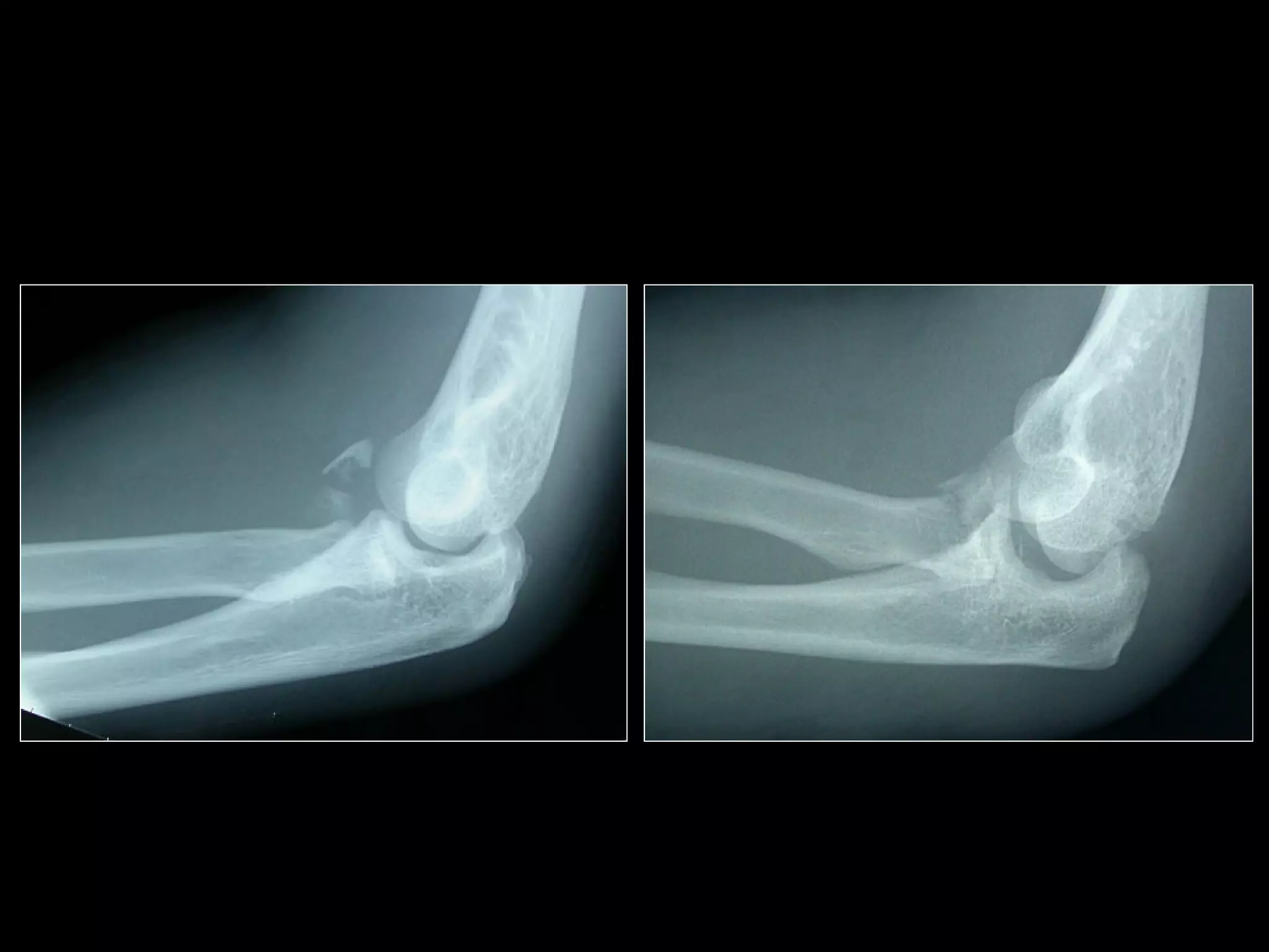 Complex Elbow Injuries Σύνθετα Κατάγματα του Αγκώνα- Complex fractures of the elbow | PPT