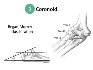 Coronoid Classification Σύνθετα Κατάγματα του Αγκώνα- Complex fractures of the elbow | PPT