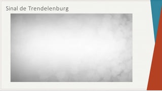 Sinal de Trendelenburg
 