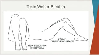Teste Weber-Barston
 