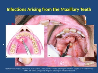 Palatal Infection Comprehensive Overview of Complex Odontogenic Infections and Deep ...